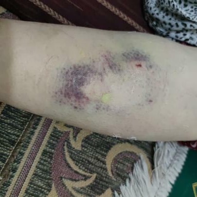 Mazıdağı’nda  köpek yaşlı kadını ısırdı
